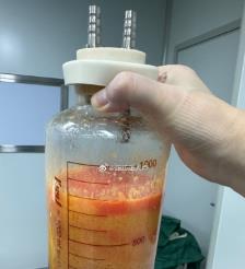 伊春水动力吸脂手术要做多久？
